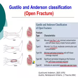 Gustilo & Anderson Open Fracture Classification